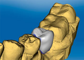 dental implant restored with cerec dental crown