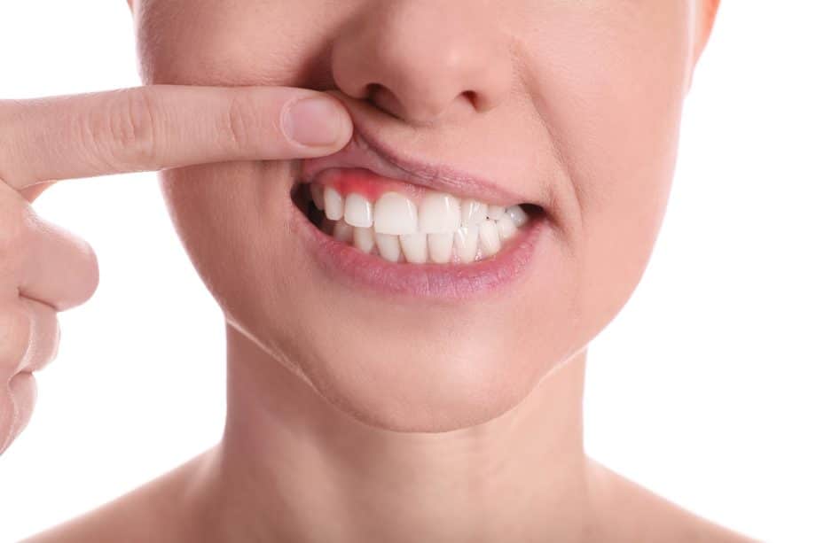 5 Early Warning Signs of Gum Disease You Shouldn’t Ignore