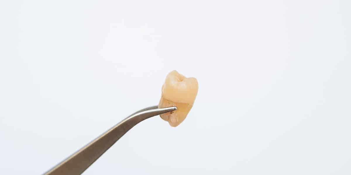 Extracted Tooth